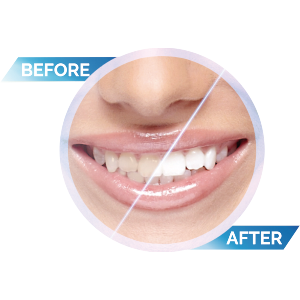 White Glo Accelerator Teeth Whitening | Birkenhead Healt ...